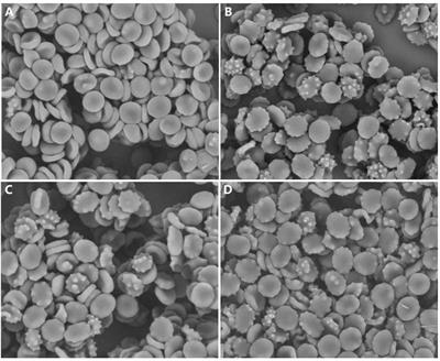 Acanthocytes Identified in Huntington’s Disease